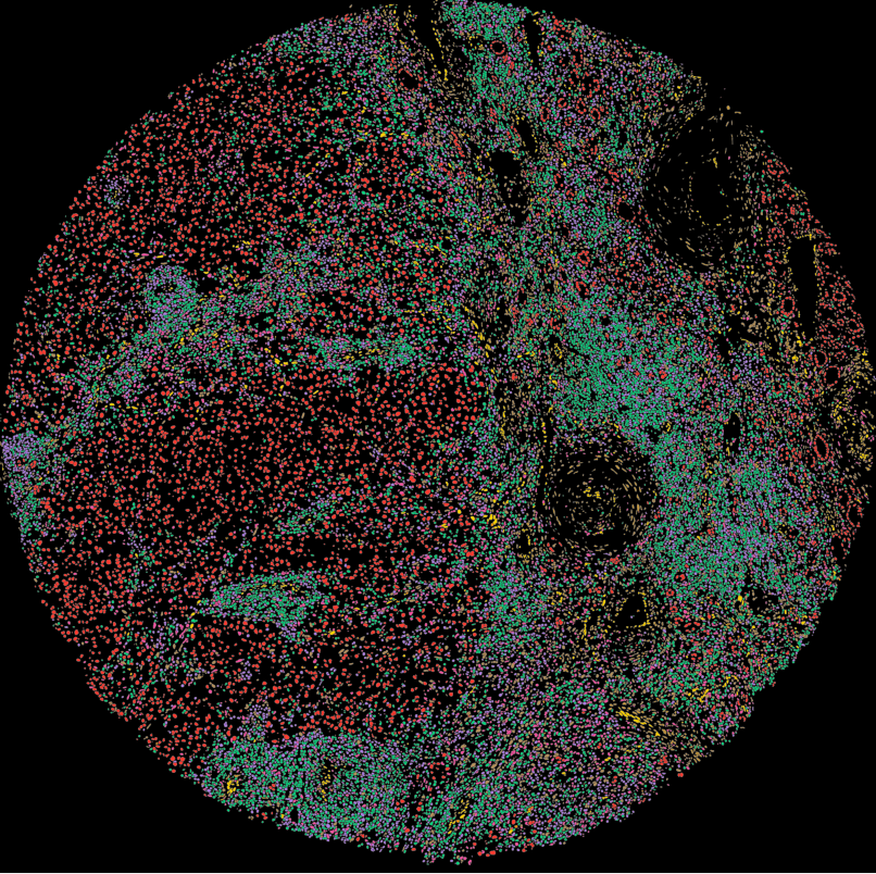A clear cell renal cell carcinoma primary tumor core read into cell-state lineages